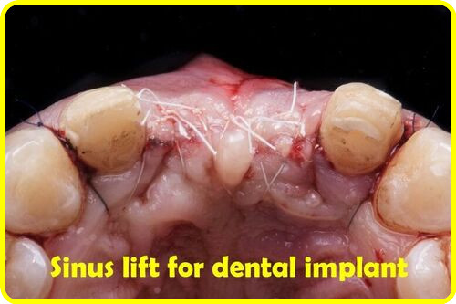 Sinus lift for dental implant image