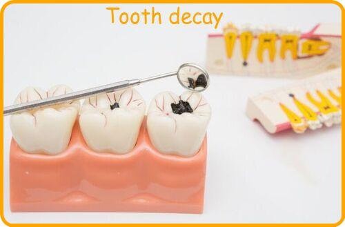 Tooth decay image
