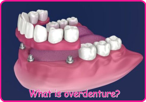 What is overdenture image