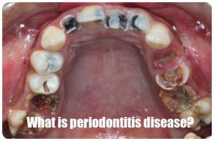 What is periodontitis disease image