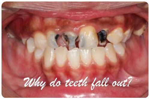 Why do teeth fall out image