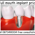 Full mouth implant price image