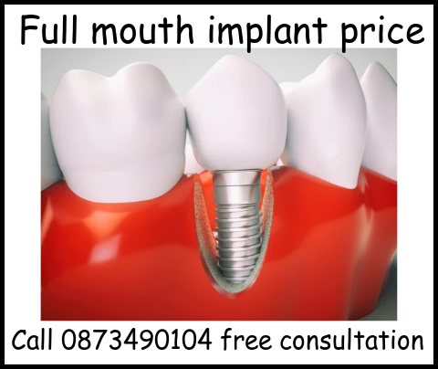 Full mouth implant price image