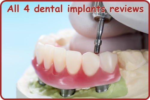 All 4 dental implants reviews image