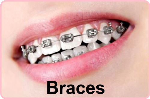 Braces image