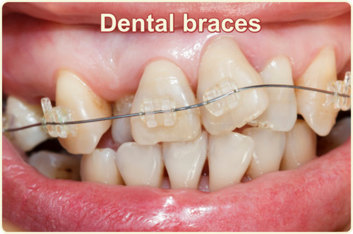 Dental braces image