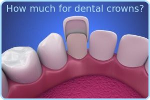 How much for dental crowns image