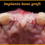 What is a bone graft for implants