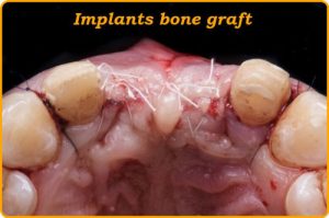 What is a bone graft for implants