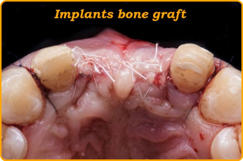 What is a bone graft for implants