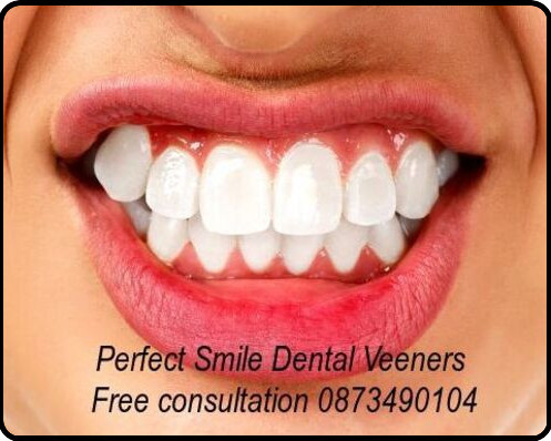 Perfect smile dental veeners image