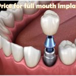 The price for full mouth implants image 3