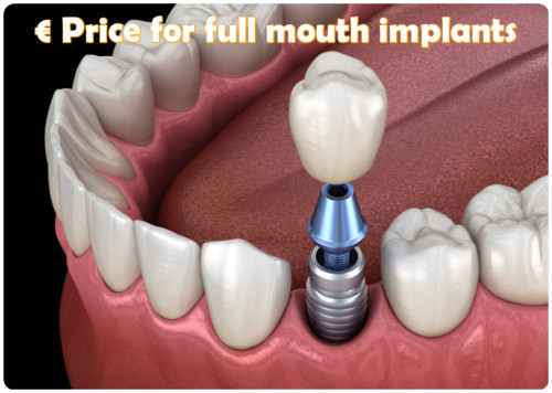 The price for full mouth implants image 3