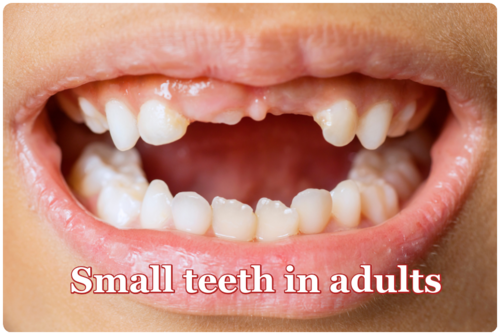 Small teeth in adults 