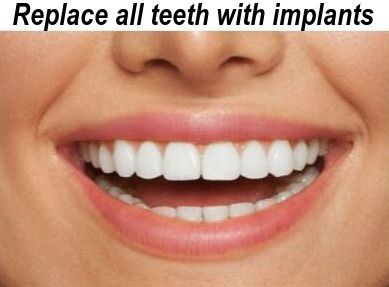 Replace all teeth with implants image