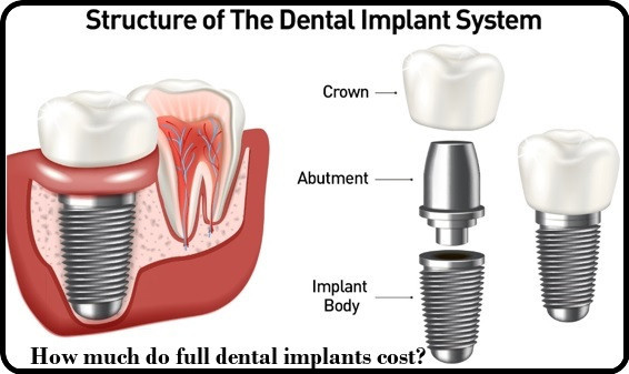 Structure of the dental implant system image