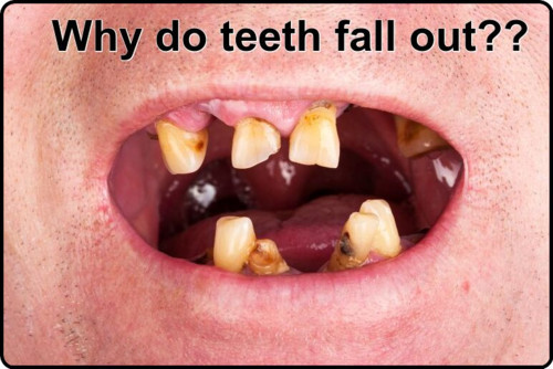 Why Do Teeth Fall Out Hungarian Dental Implant Centre Wexford Town