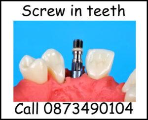 Screw in teeth image