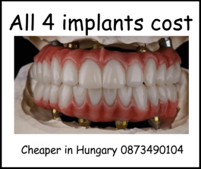 All 4 implants cost