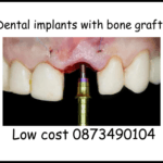 Dental implants with bone graft image