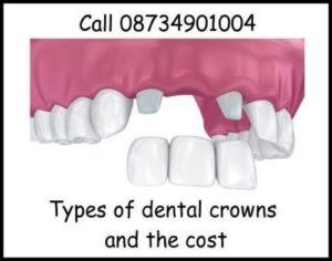 Types of dental crowns and the cost image