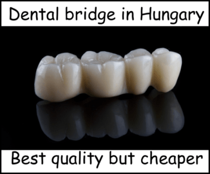 Dental bridge in Hungary image