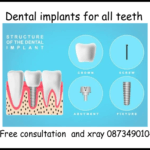 Dental implants for all teeth image
