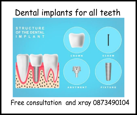 Dental implants for all teeth image