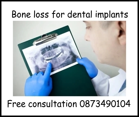 Bone loss for dental implants image