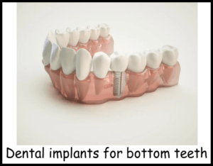 Dental implants for bottom teeth image