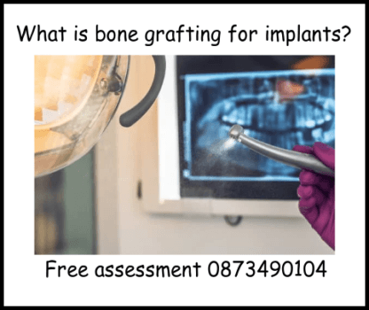 What is bone grafting for implants