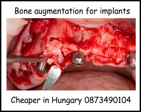 Bone augmentation for implants image