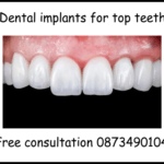 Dental implants for top teeth image