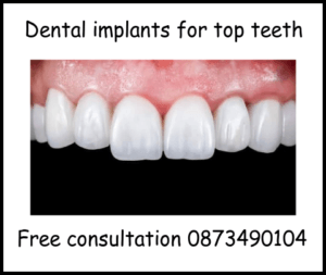 Dental implants for top teeth image