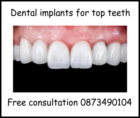 Dental implants for top teeth image