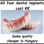All four dental implants cost image