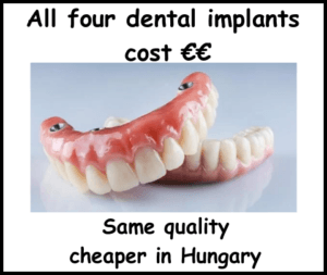 All four dental implants cost image