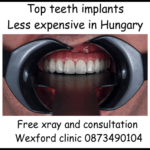 Top teeth implants image 1