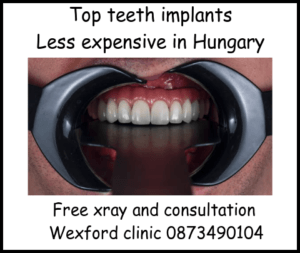 Top teeth implants image 1