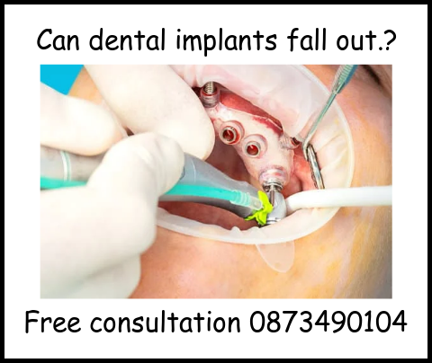 Can dental implants fall out.? image