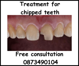 Treatment for chipped teeth image