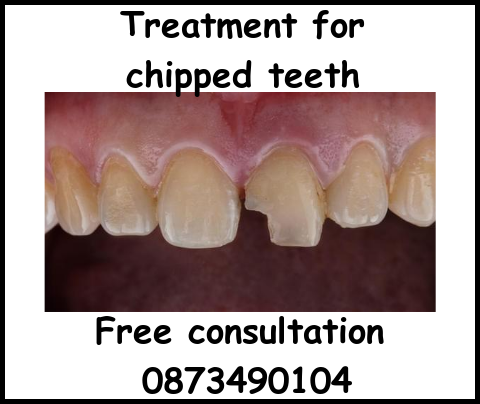 Chipped Tooth Repair Cost  East Valley Dental Professionals