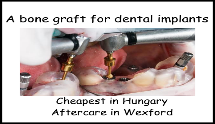 A Bone Graft For Dental Implants Hungarian Dentists Wexford