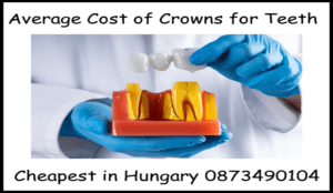 Average cost of crowns for teeth image