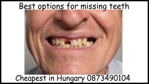 Best options for missing teeth image