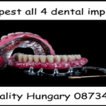 Cheapest all 4 dental implants image