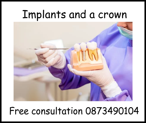 Implants and a crown image