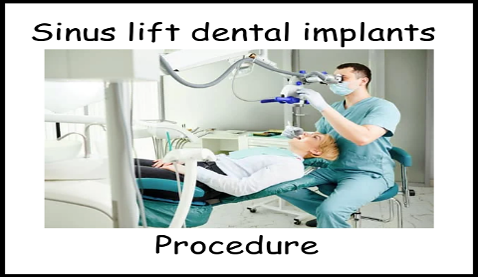 Sinus lift procedure image