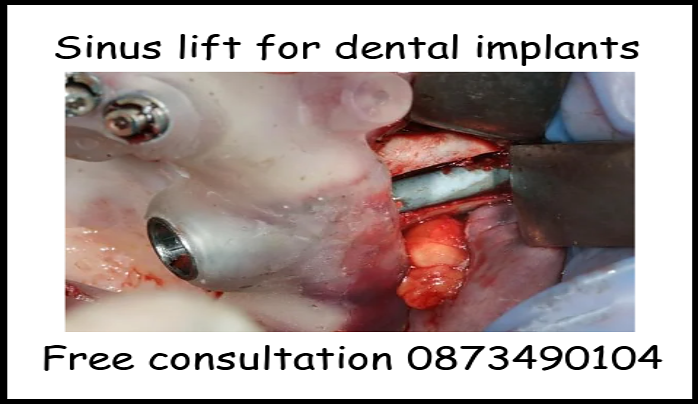 Sinus lift for dental implants image