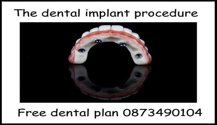 The dental implant procedure image